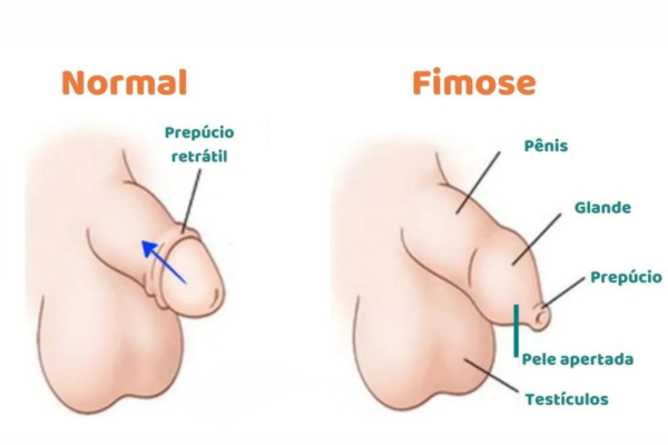 O que é fimose e por que não deve ser ignorada?
